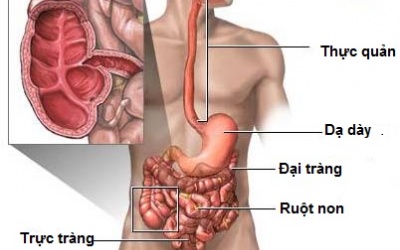 5 dấu hiệu của bệnh Crohn bạn nên biết