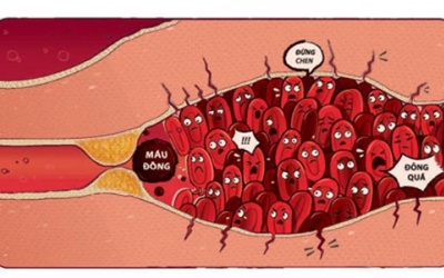 Chân sưng to bất thường cẩn thận có cục máu đông