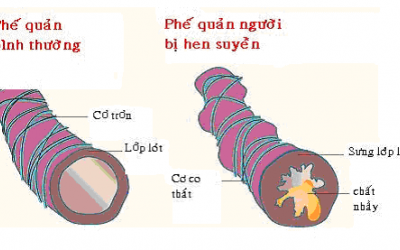 Có thể sử dụng thảo dược trong điều trị bệnh hen?
