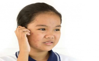 5 điều không nên làm nếu mắc bệnh thủy đậu