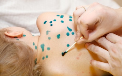TP.HCM: Phát hiện thêm ổ dịch thủy đậu ở quận Tân Bình