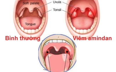 3 dấu hiệu nhận biết viêm amidan bạn nên biết