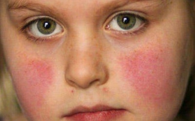 Lupus ban đỏ - Vì đâu nên nỗi?