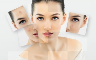 Những cách tự nhiên làm mờ sẹo do mụn không cần tới spa