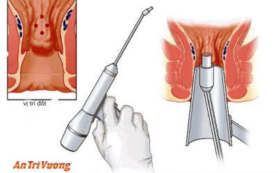 Những phương pháp điều trị bệnh trĩ