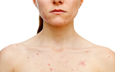Các biện pháp trị mụn trứng cá trên cơ thể