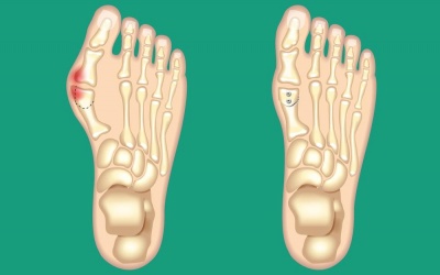 8 cách giảm đau hiệu quả cho người bị biến dạng ngón chân cái
