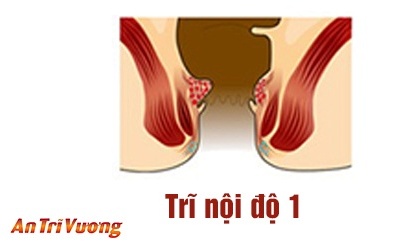 Bệnh trĩ nội độ 1 là gì và cách chữa trị