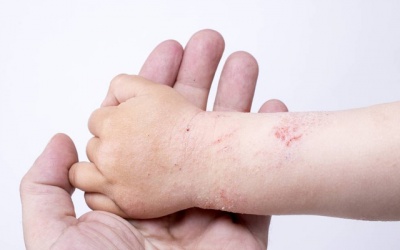 Viêm da cơ địa có nên dùng TPCN Kim Miễn Khang và Explaq?