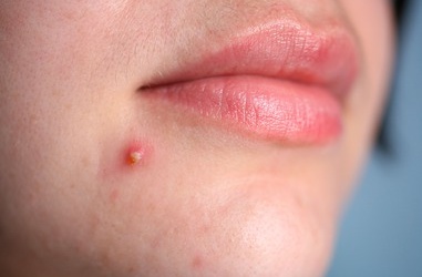 Các loại hạt tốt cho những người bị mụn trứng cá