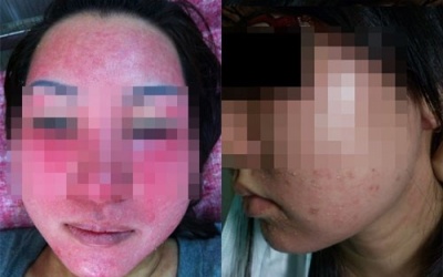Làm đẹp cấp tốc: Coi chừng khỏi ăn tết!