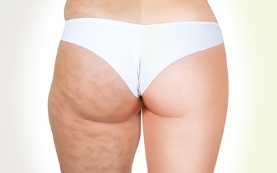 Đầy lùi chứng da sần vỏ cam bằng những biện pháp tự nhiên