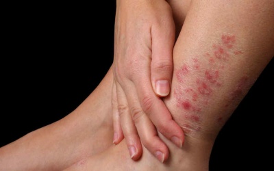 Làm sao để giảm đỏ da do vẩy nến?