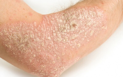 Làm sao để loại bỏ tế bào da chết do vẩy nến?