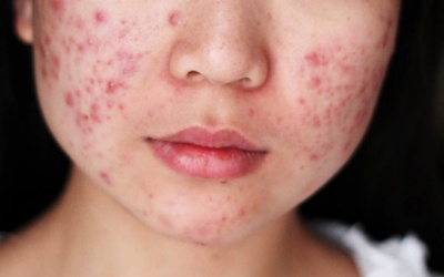 Nổi nhiều mụn sau khi uống thuốc giải độc gan phải làm sao?