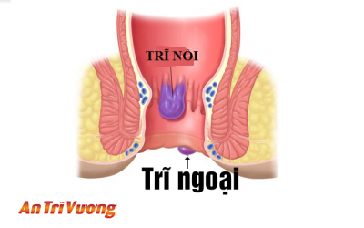 Tìm hiểu về bệnh trĩ và cách phòng tránh bệnh trĩ hiệu quả