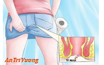Trĩ ngoại và cách điều trị bệnh trĩ ngoại 