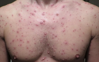Hà Nội: Lây thủy đậu từ con trẻ, nhiều người lớn nhập viện