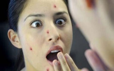 Người lớn đừng để phải hối hận vì bệnh thủy đậu