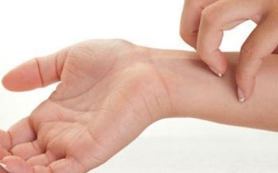 Bị viêm da tự miễn có nên dùng TPCN Kim Miễn Khang?