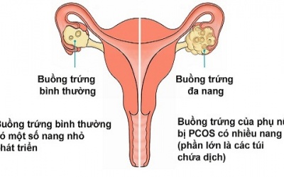 6 điều bạn chưa biết về hội chứng buồng trứng đa nang