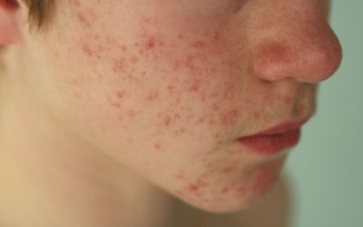 Bí quyết đánh bay mụn trứng cá ở tuổi dậy thì