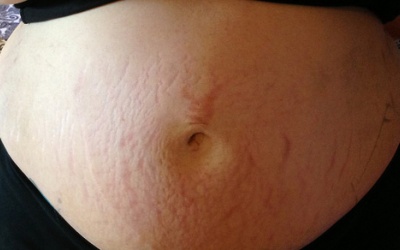 Rạn da sau sinh đã lâu có nên dùng Babolica?