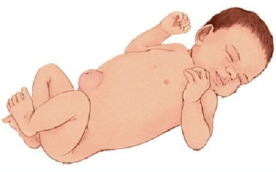 Đừng chủ quan khi trẻ bị lồi rốn