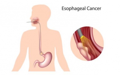 5 triệu chứng của bệnh ung thư thực quản mà bạn cần lưu ý