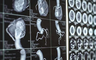 Nghiên cứu trái tim người để cải thiện điều trị rung nhĩ