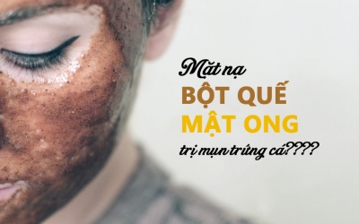 Thực hư mặt nạ mật ong quế trị mụn trứng cá