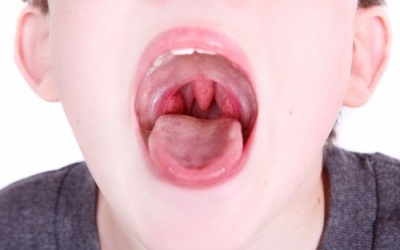 Liên cầu khuẩn tan huyết nhóm A thường gây viêm họng