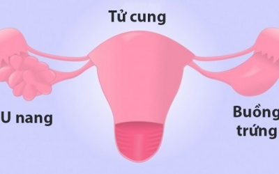 6 suy nghĩ sai thường gặp về hội chứng buồng trứng đa nang