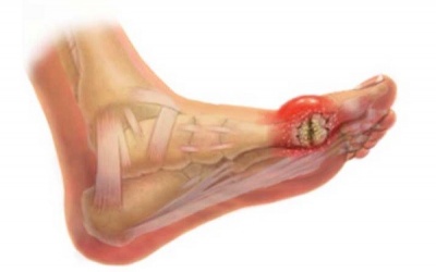 Lời khuyên bác sỹ: Chữa khỏi bệnh gout không phải thuốc, mà do bí quyết 'ĂN ít, ỘP nhiều'