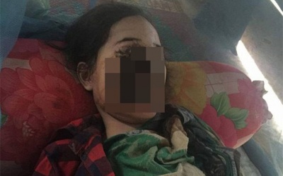 Thiếu nữ 18 tuổi bị phá hủy khuôn mặt sau khi nhổ 1 chiếc răng và đây là nguyên nhân