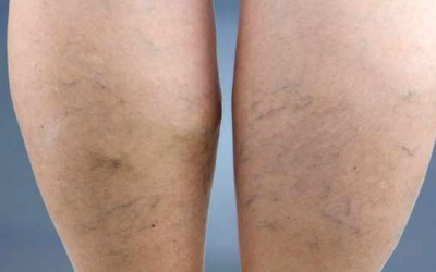 5 điều bạn nên biết về giãn tĩnh mạch
