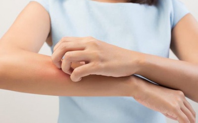 Mùa nồm ẩm: Đề phòng nổi mề đay, phát ban