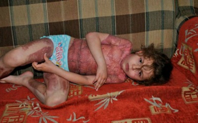 Bé 5 tuổi bị bỏng nặng vì trò lừa đảo trên mạng