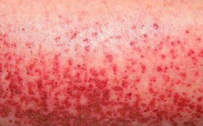 Nhiều người chết vì sốt xuất huyết, người dân vẫn thờ ơ