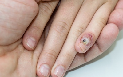 Xét nghiệm HPV như thế nào và ai là đối tượng dễ nhiễm HPV nhất?