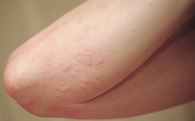 Người bị mề đay nên ăn gì?