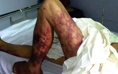 Dễ điếc, tử vong vì nhiễm liên cầu khuẩn lợn