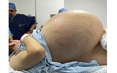 Mang u nang buồng trứng nặng bằng 10 bé sơ sinh