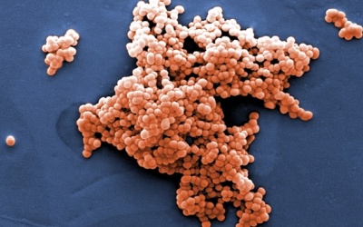 Người đàn ông phải cắt cụt tay chân do viêm họng liên cầu khuẩn