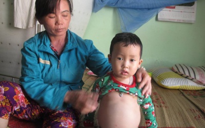 Mắc bệnh gan nặng, bé trai 4 tuổi bụng to như cái trống