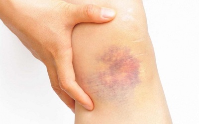 Vết bầm tím trên da mãi không khỏi là bị làm sao?