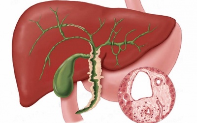 Các biện pháp tự nhiên hỗ trợ điều trị bệnh xơ gan ứ mật
