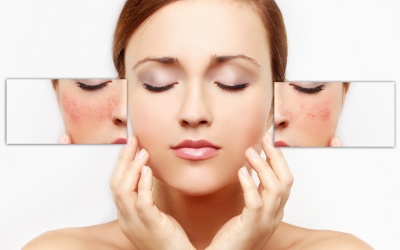 Giao mùa, da nhạy cảm nổi mụn chi chít phải làm sao?