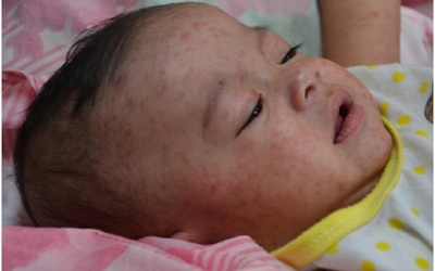 Bệnh sởi lây lan khắp châu Âu