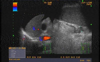 Điều trị xơ gan cổ trướng bằng phương pháp hấp thu dịch